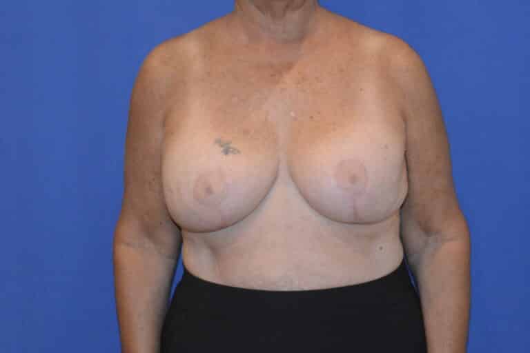 After Image: Breast Implant Revision – Reaugmentation and Lift - front