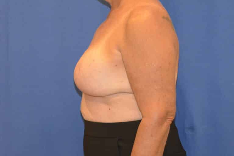After Image: Breast Implant Revision – Reaugmentation and Lift - left-side