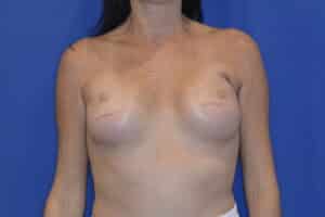 After Image: Breast Reconstruction