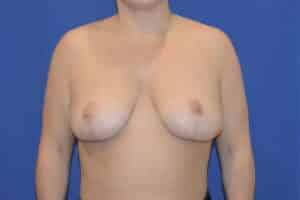 After Image: Breast Reduction