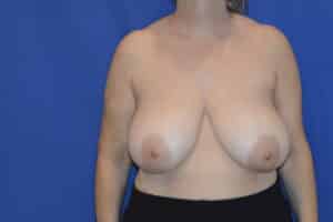 Before Image: Breast Reduction
