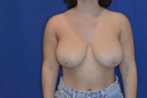 Before Image: Breast Reduction