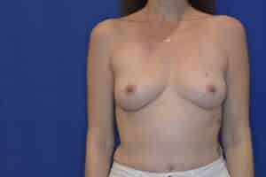 Before Image: Breast Reconstruction