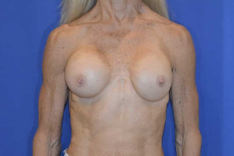Before Image: Breast Implant Revision - front