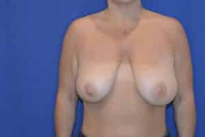 Before Image: Breast Reduction