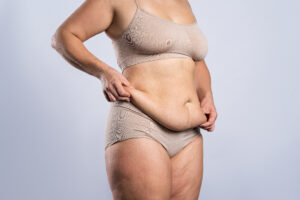 woman's body showing excess skin on stomach region and legs after weight loss