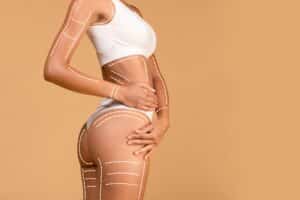 Woman in white underwear and sports bra with body contouring lines drawn on her body representing areas typically targeted for liposuction