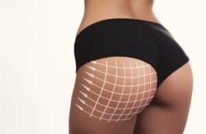 Woman in black underwear with diagram markings indicating fat transfer area on buttocks.