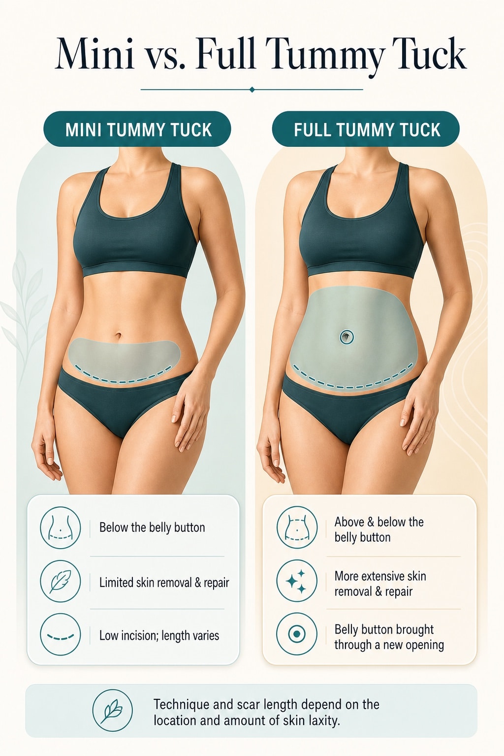Comparison of mini and full tummy tuck treatment areas, abdominal-wall repair, incision length, and belly-button placement.