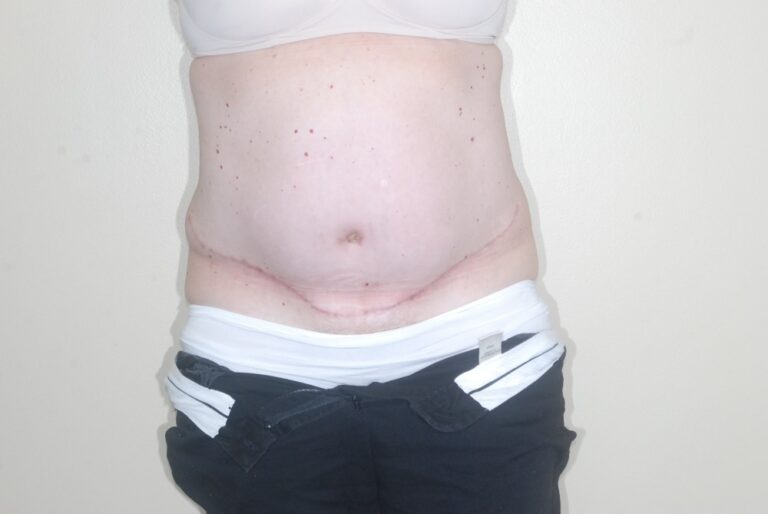 After Image: Tummy Tuck – Before & After Case 11 - front