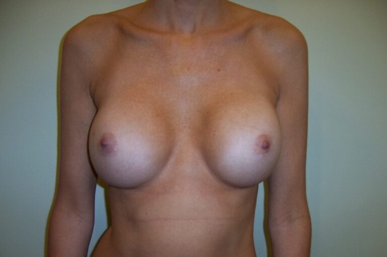 Before Image: Breast Reconstruction – Implant Based – Before & After Case 01 - front