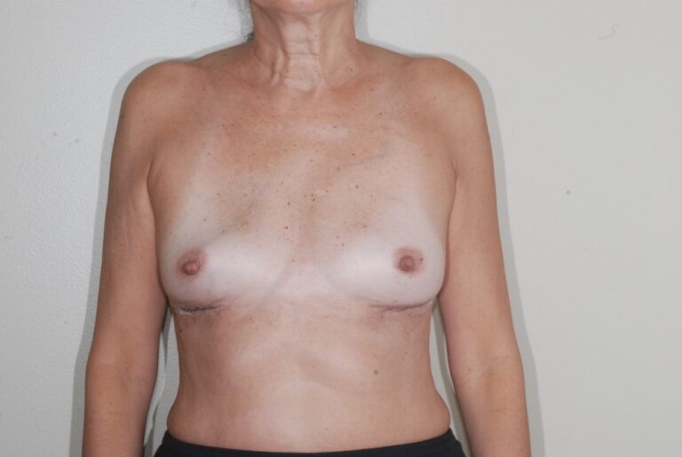 After Image: Breast Implant Removal – Before & After Case 05 - front