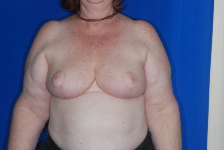 After Image: Breast Reduction – Before & After Case 13 - front