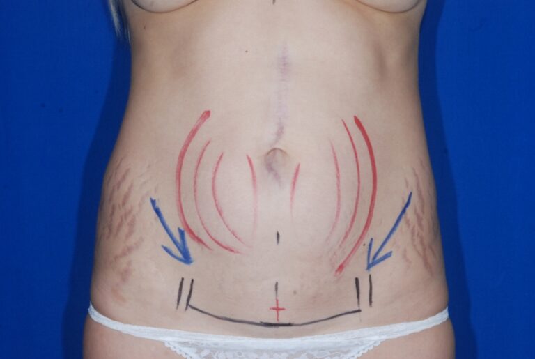 Before Image: Tummy Tuck – Mini – Before & After Case 07 - front