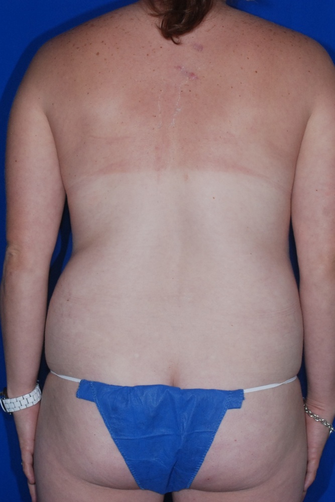 Before Image: Liposuction – Back and Flanks – Before & After Case 02 - back
