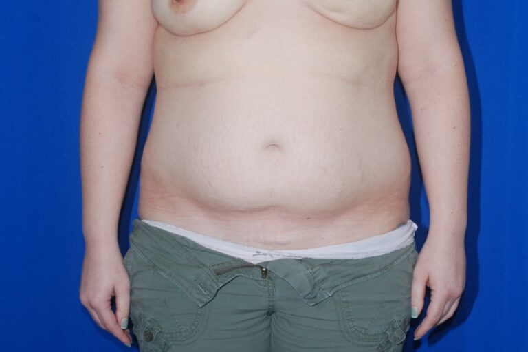 Before Image: Tummy Tuck – Before & After Case 03 - front