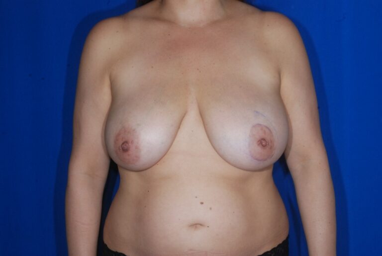 Before Image: Breast Reduction – Before & After Case 17 - front
