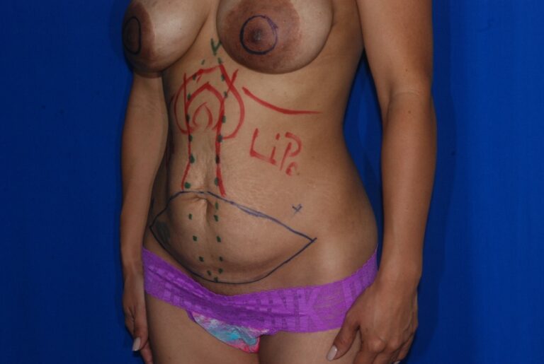 Before Image: Mommy Makeover – ReAug/Pexy/TT – Before & After Case 07 - left-front-oblique