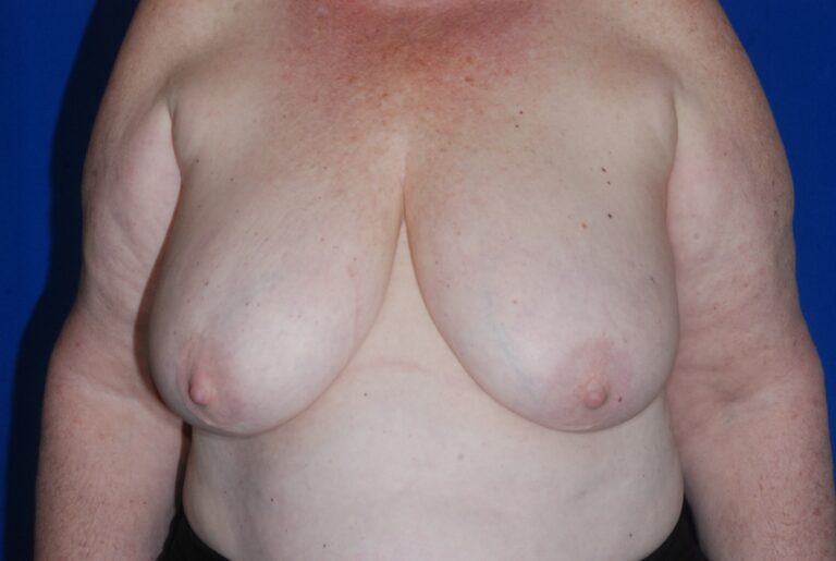 Before Image: Breast Reduction – Before & After Case 13 - front