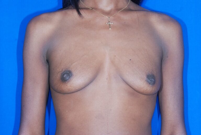 Before Image: Breast Augmentation – Before & After Case 12 - front