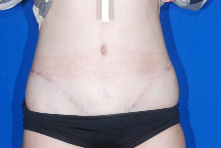After Image: Tummy Tuck – Before & After Case 05 - front