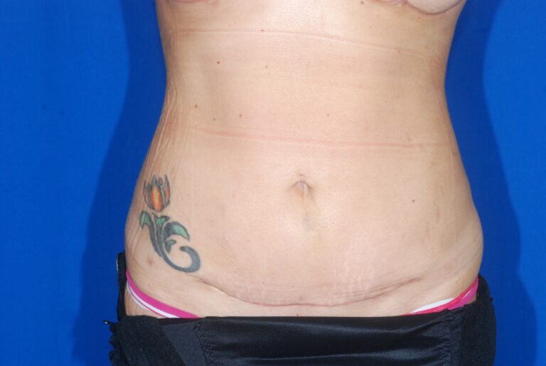 After Image: Tummy Tuck – Mini with Lipo – Before & After Case 06 - front