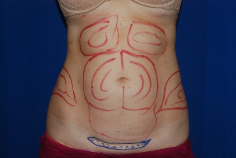 Before Image: Liposuction – Abdomen/Flanks – Before & After Case 06 - front