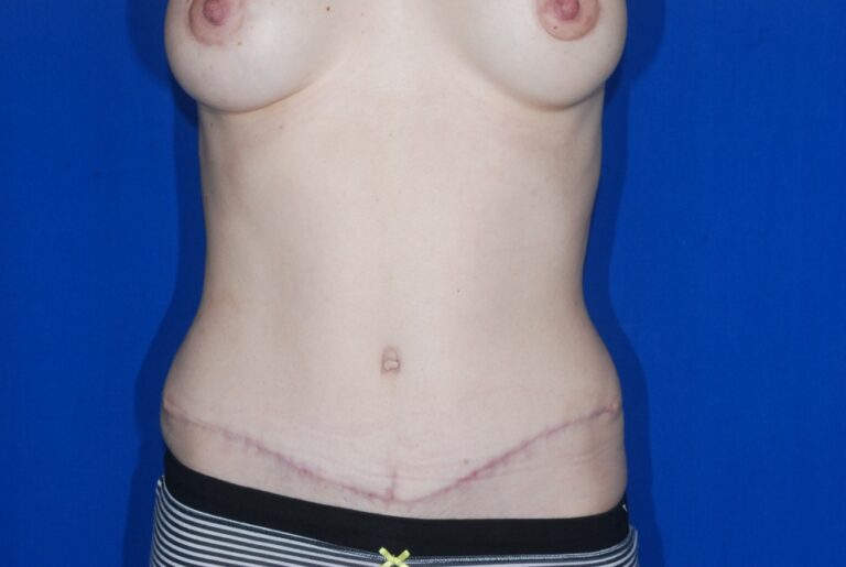 After Image: Tummy Tuck – Before & After Case 08 - front