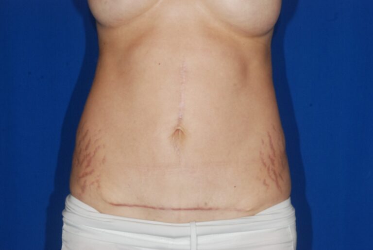 After Image: Tummy Tuck – Mini – Before & After Case 07 - front