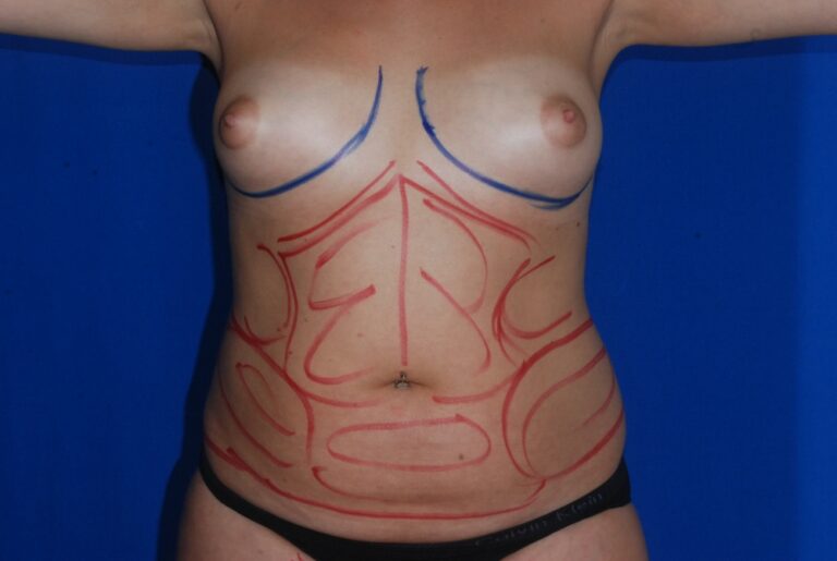 Before Image: Liposuction – Abdomen/Flanks – Before & After Case 07 - front