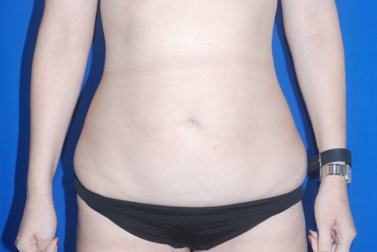 Before Image: Tummy Tuck – Before & After Case 05 - front