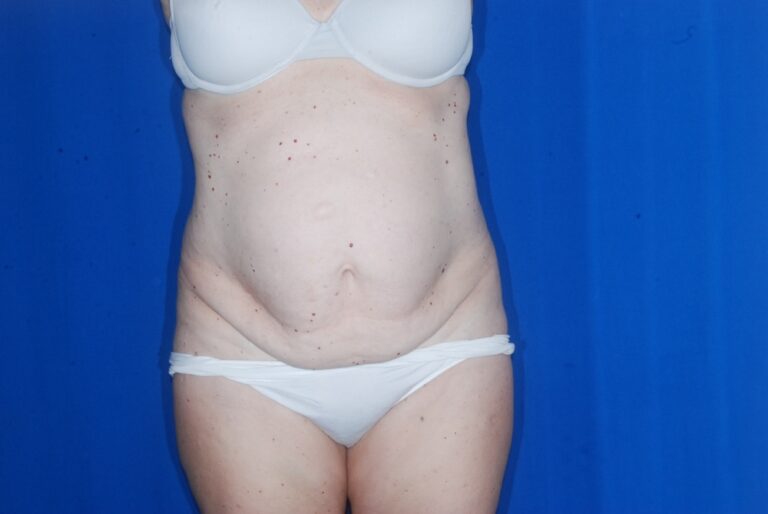 Before Image: Tummy Tuck – Before & After Case 11 - front