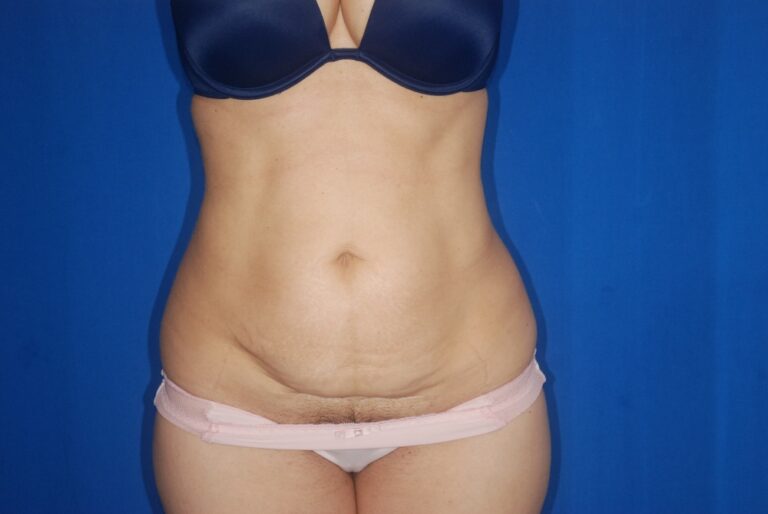Before Image: Tummy Tuck – Before & After Case 14 - front