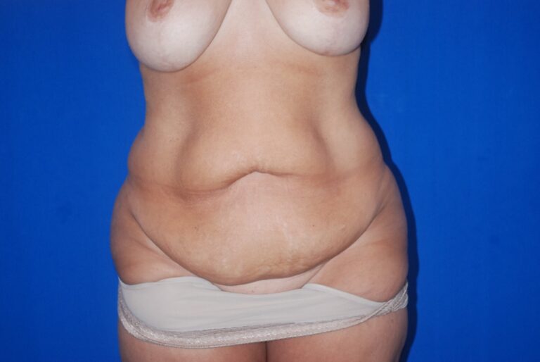 Before Image: Tummy Tuck – Before & After Case 12 - front