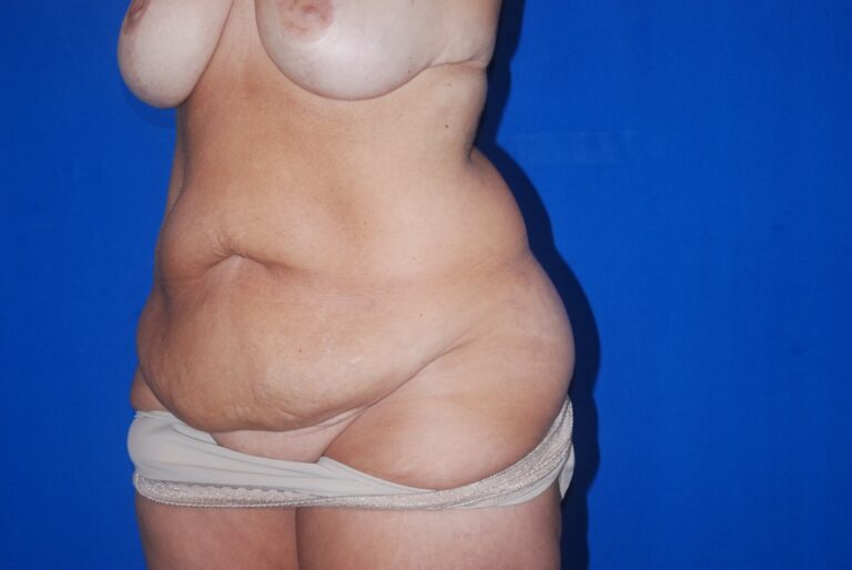 Before Image: Tummy Tuck – Before & After Case 12 - left-front-oblique