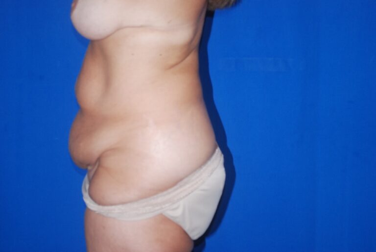 Before Image: Tummy Tuck – Before & After Case 12 - left-side