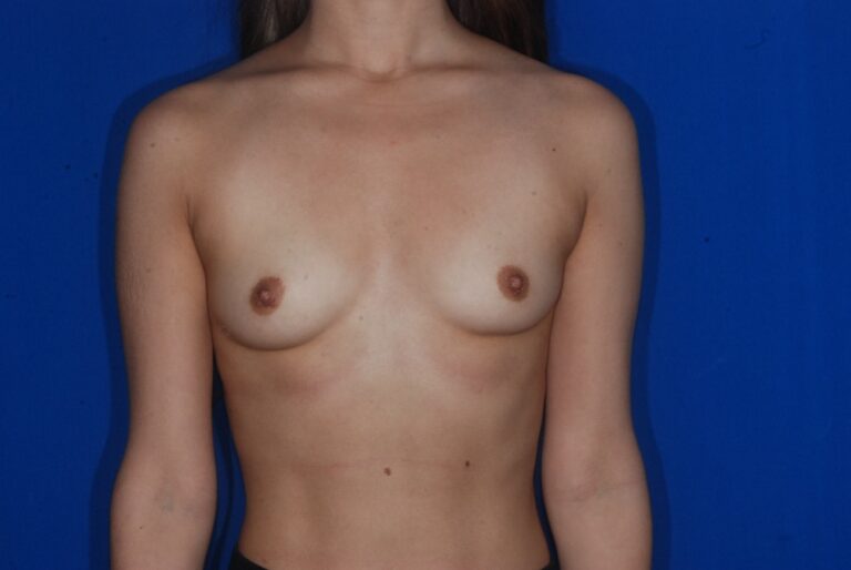Before Image: Breast Augmentation – Before & After Case 26 - front