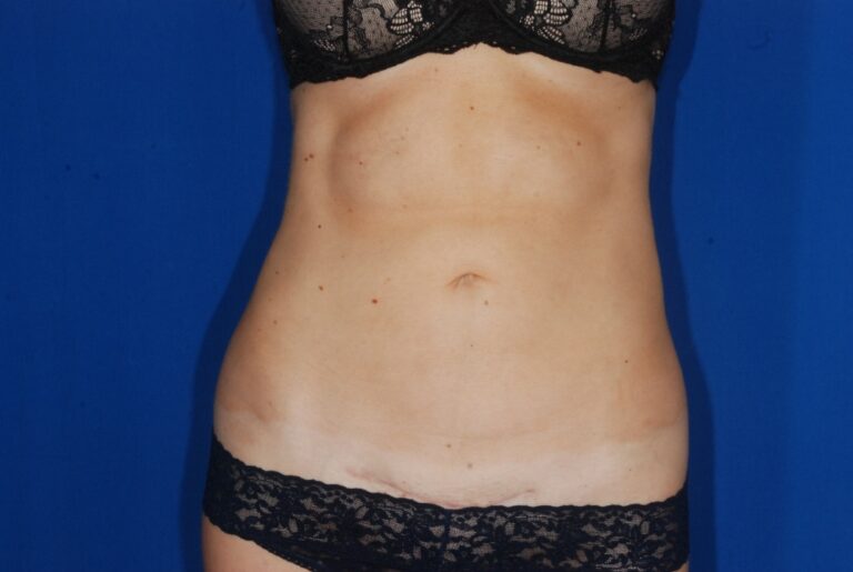 After Image: Liposuction – Abdomen/Flanks – Before & After Case 06 - front