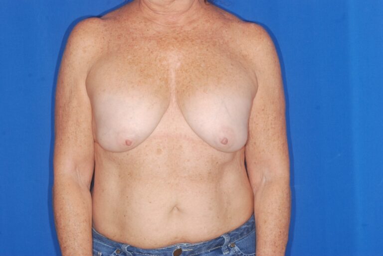 Before Image: Breast Implant Removal with Lift – Before & After Case 06 - front