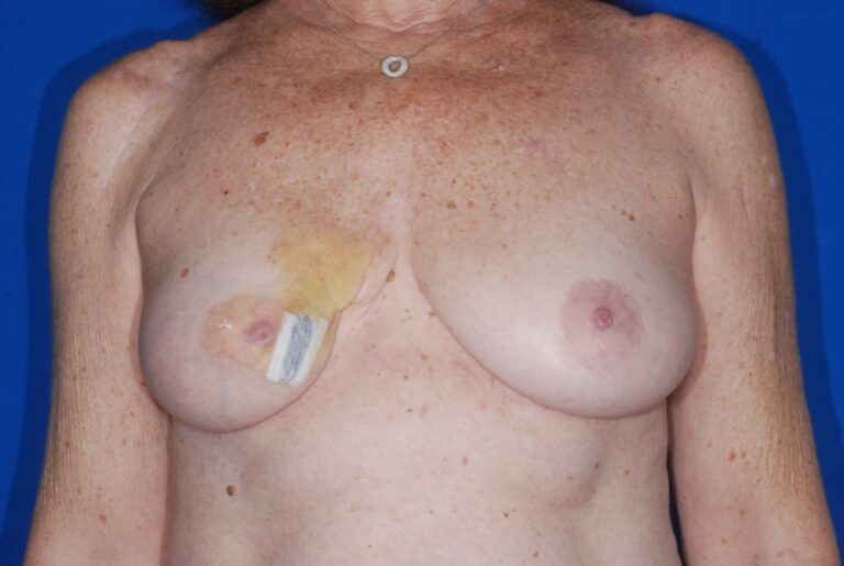 Before Image: Breast Reconstruction – Latissimus Flap – Before & After Case 43 - front
