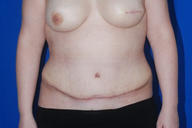 After Image: Tummy Tuck – Before & After Case 03 - front
