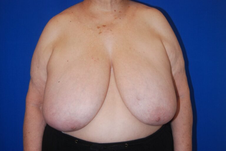 Before Image: Breast Reconstruction – Oncoplastic Reduction – Before & After Case 11 - front