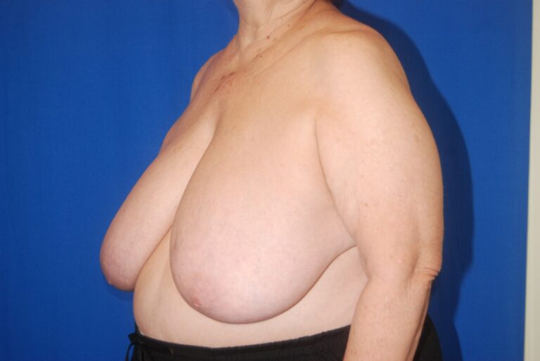 Before Image: Breast Reconstruction – Oncoplastic Reduction – Before & After Case 11 - left-front-oblique