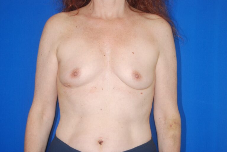 Before Image: Breast Reconstruction- Implant Based – Before & After Case 14 - front