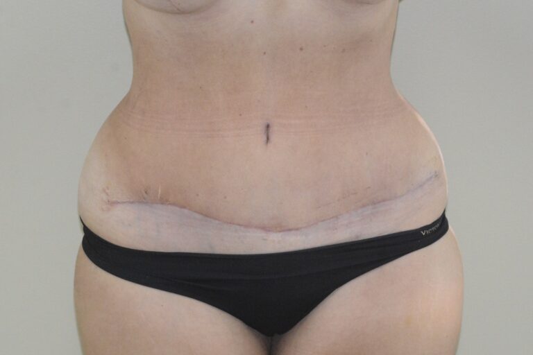 After Image: Tummy Tuck – Before & After Case 13 - front