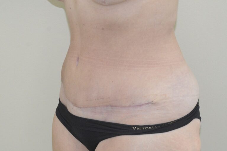 After Image: Tummy Tuck – Before & After Case 13 - left-front-oblique