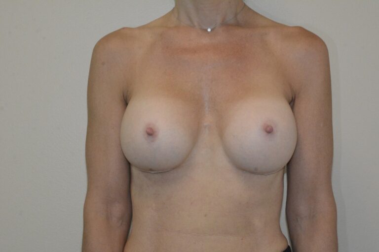After Image: Breast Implant Revision – Before & After Case 27 - front