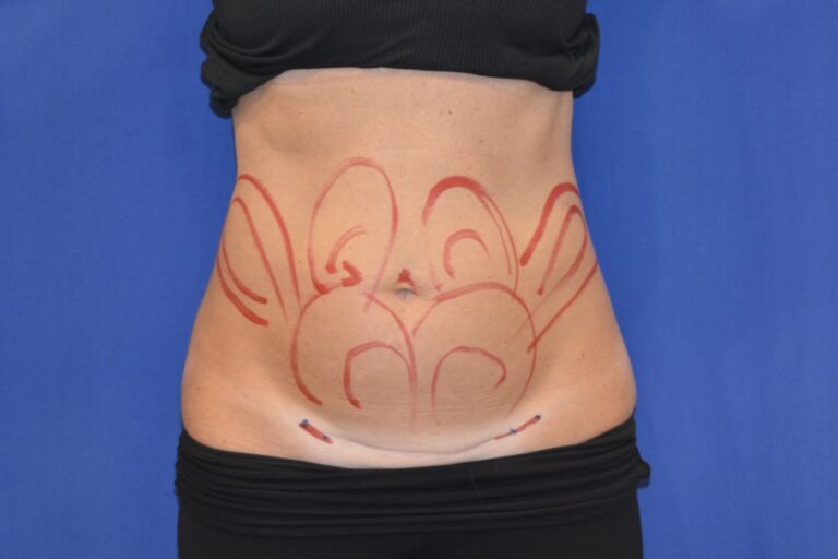 Before Image: Liposuction Abd/Flanks with Mini-TT – Before & After Case 14 - front