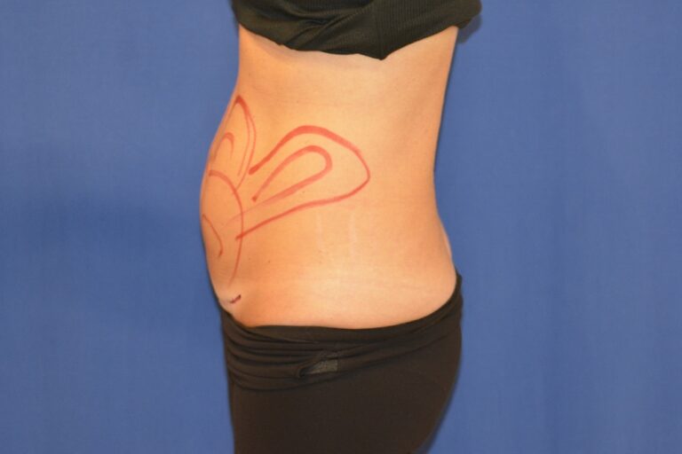 Before Image: Liposuction Abd/Flanks with Mini-TT – Before & After Case 14 - left-side