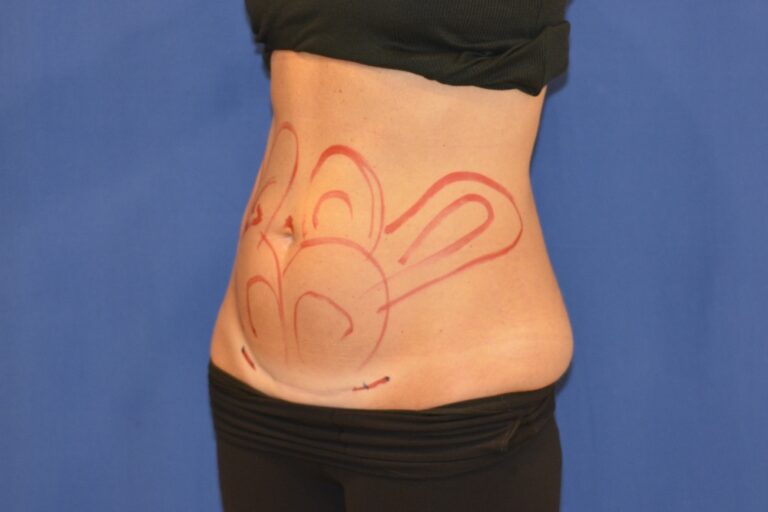 Before Image: Liposuction Abd/Flanks with Mini-TT – Before & After Case 14 - left-front-oblique